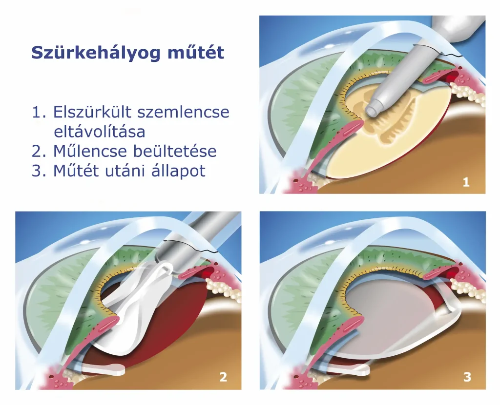 Szürkehályog műtét lépései